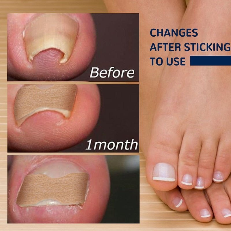 Ingrown Nail Corrector - LightsBetter