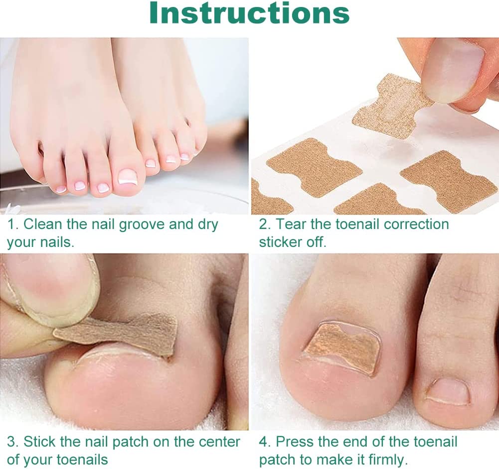 Ingrown Nail Corrector - LightsBetter