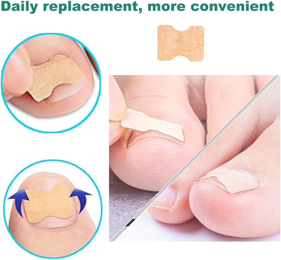 Ingrown Nail Corrector - LightsBetter