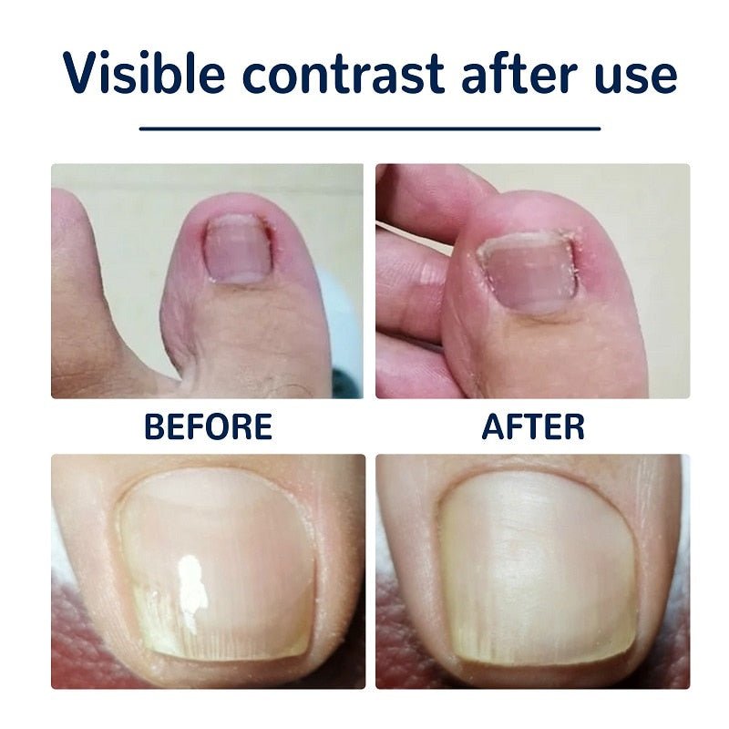 Ingrown Nail Corrector - LightsBetter