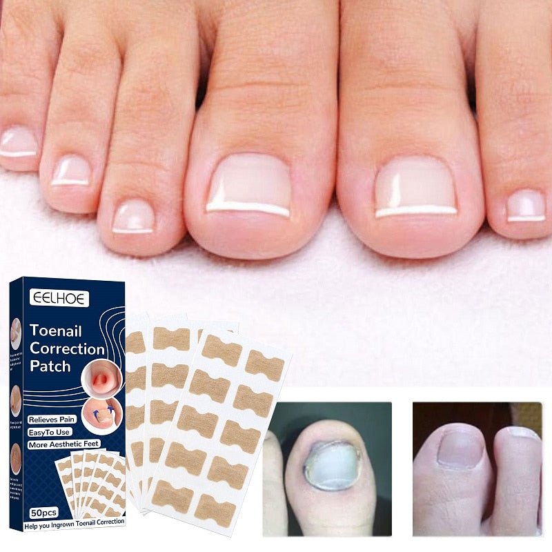 Ingrown Nail Corrector - LightsBetter