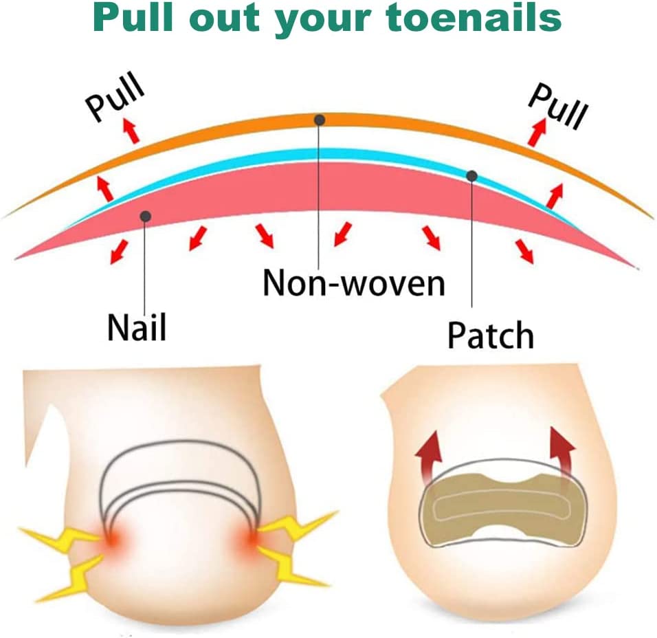 Ingrown Nail Corrector - LightsBetter